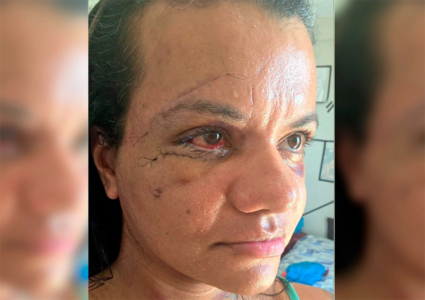 Mulher agredida com mais de 60 socos mostra rosto após cirurgia de reconstrução facial