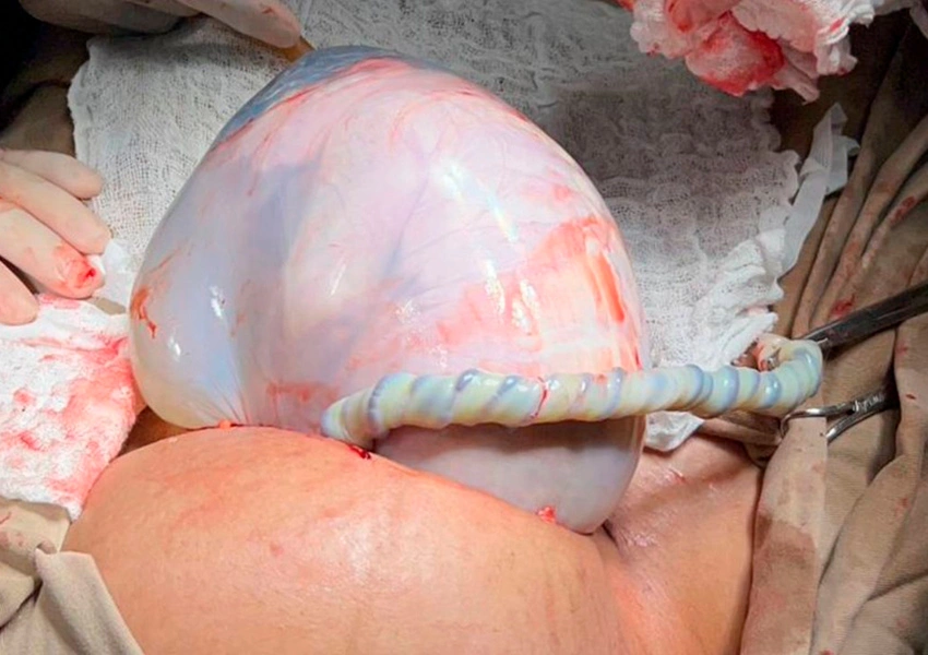 Parto empelicado raro acontece duas vezes no mesmo dia na Bahia