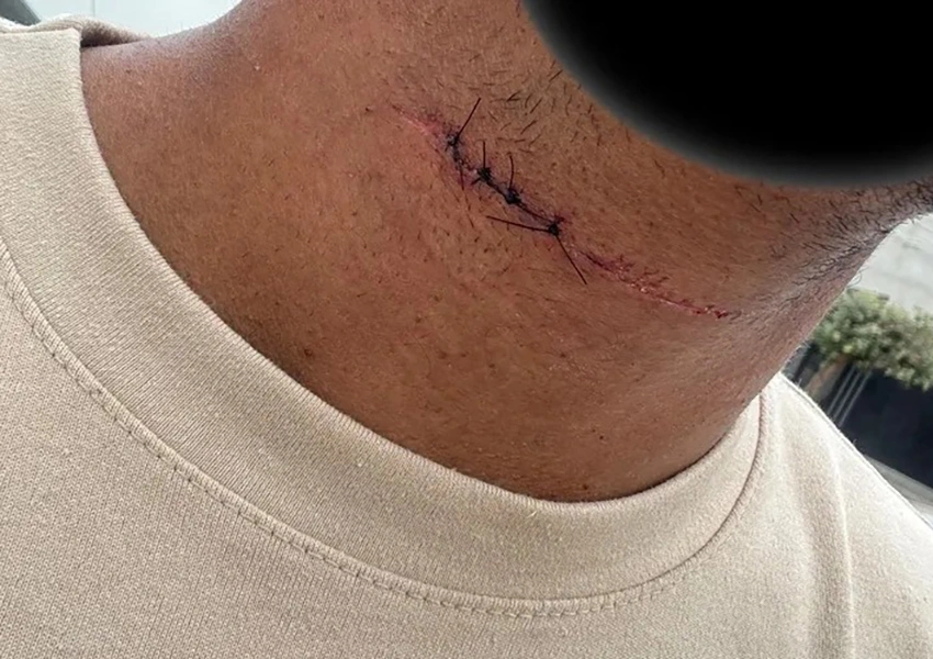 Linha de pipa com cerol corta pescoço de estudante de direito horas antes da formatura em Brumado